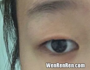 双眼皮胶水有副作用吗,娥佩兰双眼皮胶水功效和双眼皮胶水的危害都有哪些？