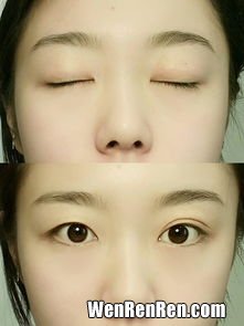 双眼皮胶水有副作用吗,娥佩兰双眼皮胶水功效和双眼皮胶水的危害都有哪些？